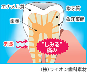 知覚過敏：歯がしみる原因
