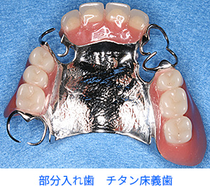 部分入れ歯　チタン床義歯