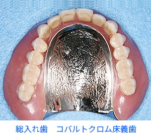 コバルトクロム合金　金属床総義歯