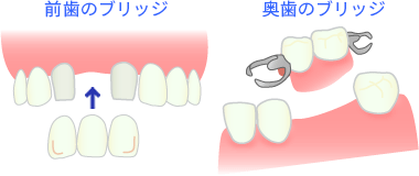 ブリッジによる治療