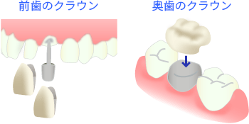 クラウンによる虫歯の修復