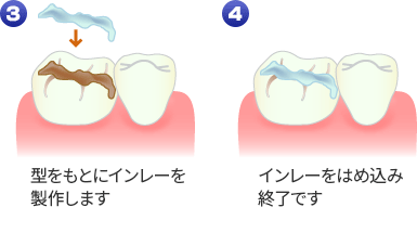 インレー修復法