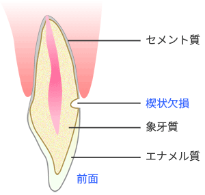 知覚過敏と楔状欠損