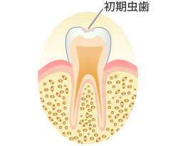 CO：初期虫歯