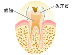 C2：象牙質の虫歯