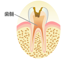 C3：歯の神経（歯髄）の虫歯