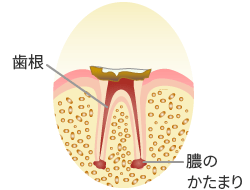 C4：末期の虫歯