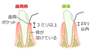 歯周ポケットの検査