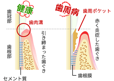 歯肉溝と歯周ポケット