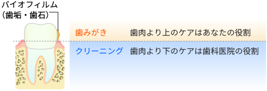 定期管理による歯のクリーニング（PMTC）