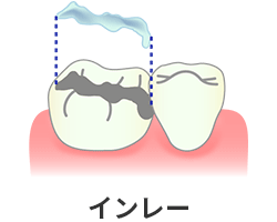 セラミック・インレー