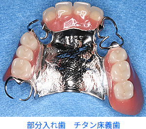 チタン合金　金属床総義歯