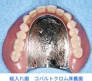 総入れ歯　コバルトクロム義歯