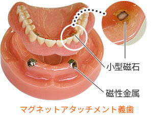 マグネット・アタッチメント義歯