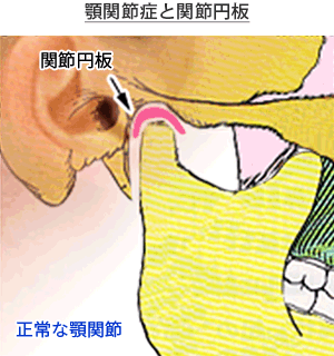 顎関節症と関節円板