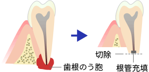 歯根端切除術