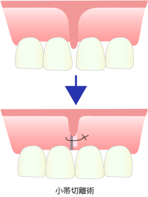 小帯切除術