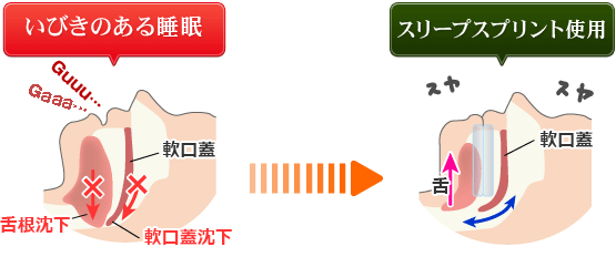いびきをスリープスプリントで防止