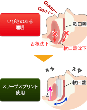 いびきをスリープスプリントで防止