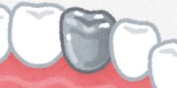 銀歯イラスト